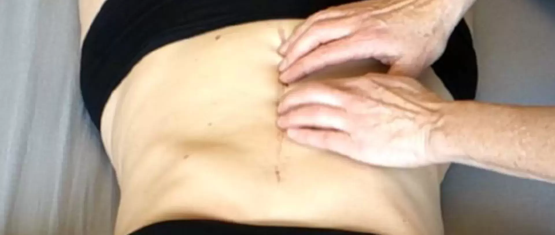 Rolfing® und Narben