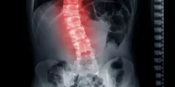 Finding Relief from Scoliosis Through Rolfing®